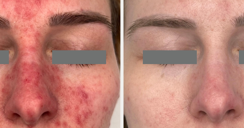 Side-by-side close-up of a persons face, showing red, inflamed skin with acne on the left and clearer, smoother skin on the right. Eyes are covered by gray bars for anonymity.